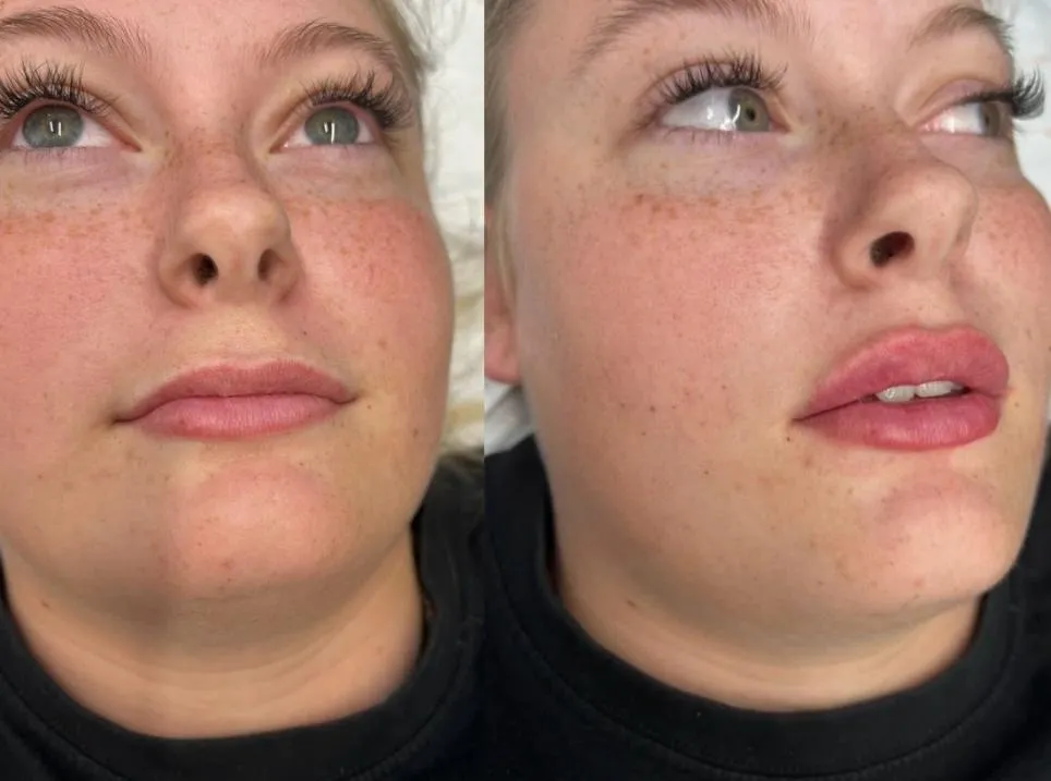 Empire Medical Clinic Dermal Fillers (1)