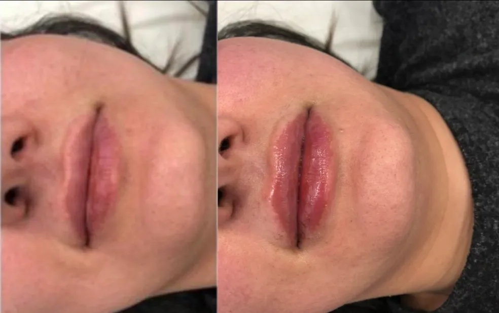 Empire Medical Clinic Dermal Fillers (2)