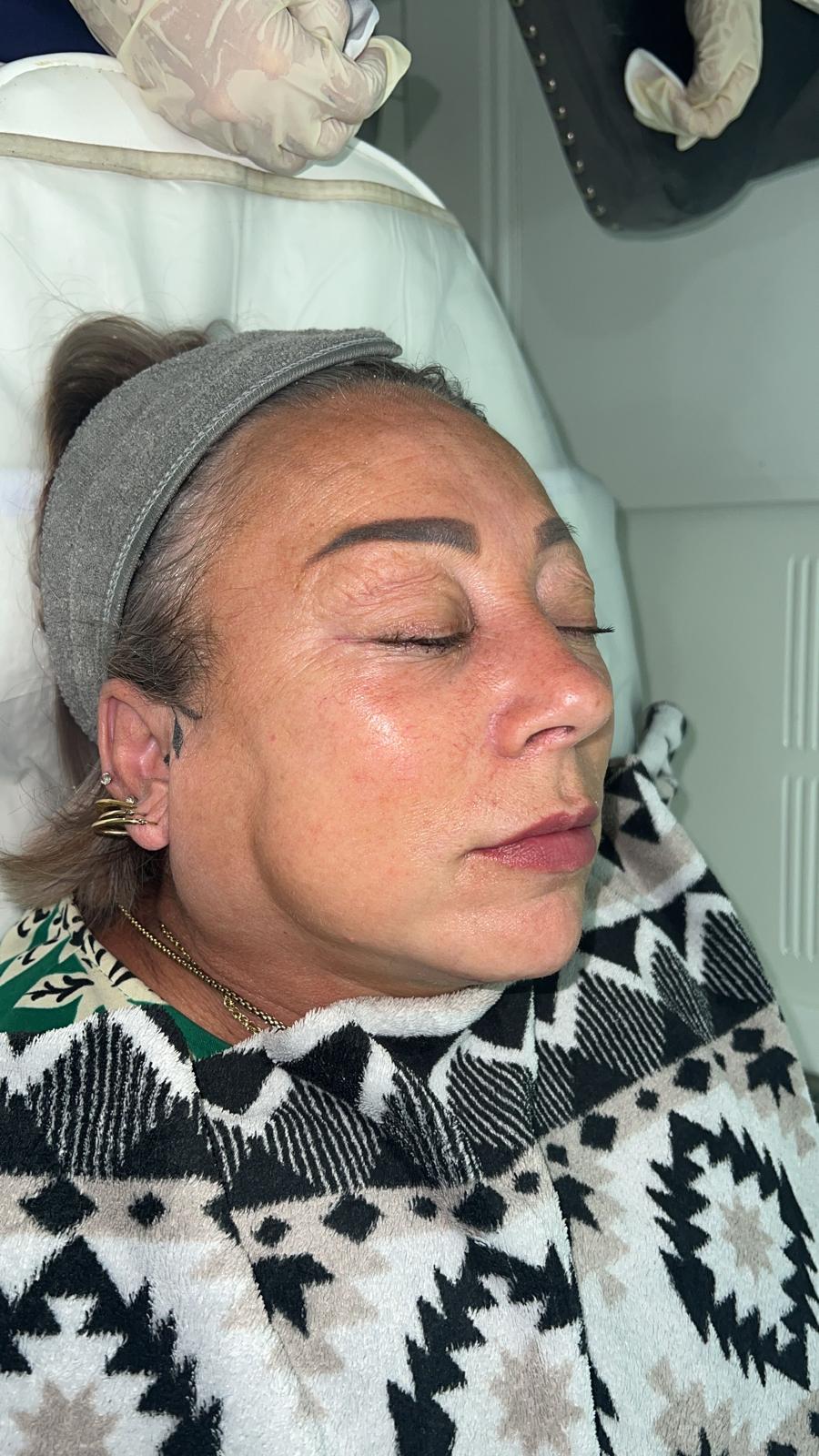oxybrasion facial
